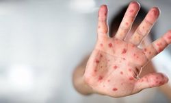 10 soruda 'maymun çiçeği' hastalığı