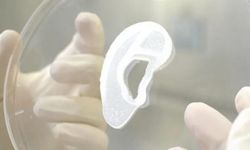 3D yazıcı ile yapılan kulak, hastaya nakledildi
