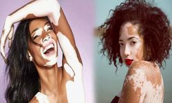 Vitiligo hastalığı nedir? Nasıl tedavi edilir?