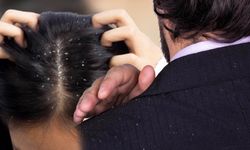 Saç kepeğine doğal çözüm nedir? Evde nasıl geçer?