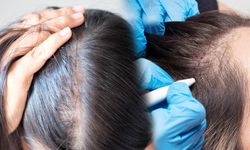 Saç Ekimi Tarih Oluyor! 7 Alternatif Çözüm