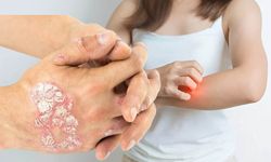 Türkiye’de Cüzzam Uyarısı: Dr. Egi Losol Açıklıyor