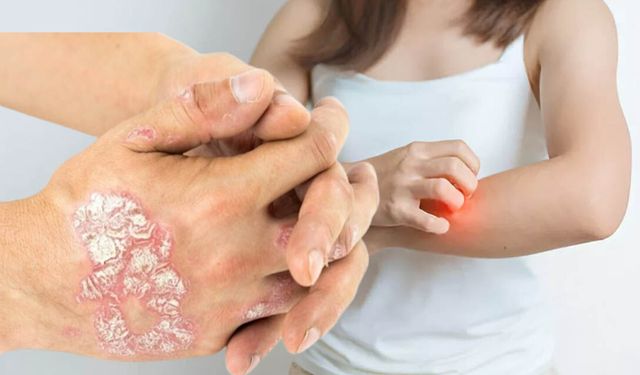 Türkiye’de Cüzzam Uyarısı: Dr. Egi Losol Açıklıyor