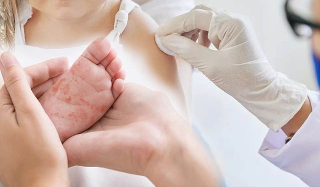 D.C.’de Kızamık Vakaları Arttı: Yetkililer Halkı Uyarıyor