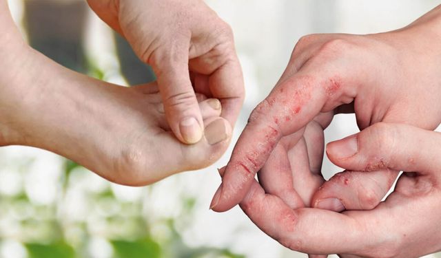 El ve ayak mantarı geçmiyorsa evde bunları dene