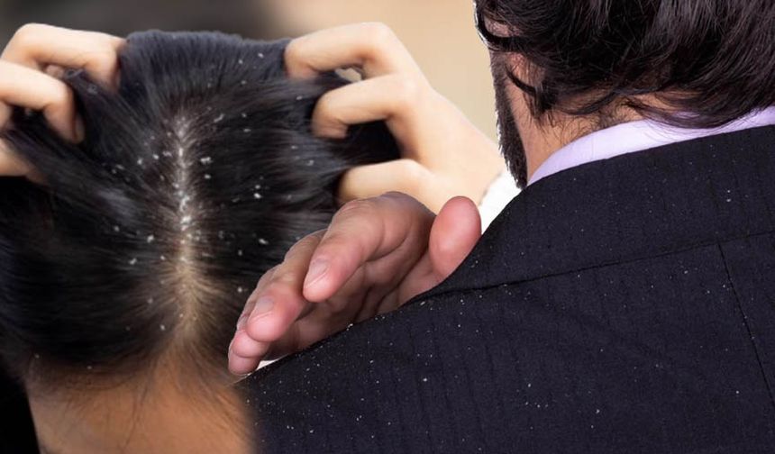 Saç kepeğine doğal çözüm nedir? Evde nasıl geçer?