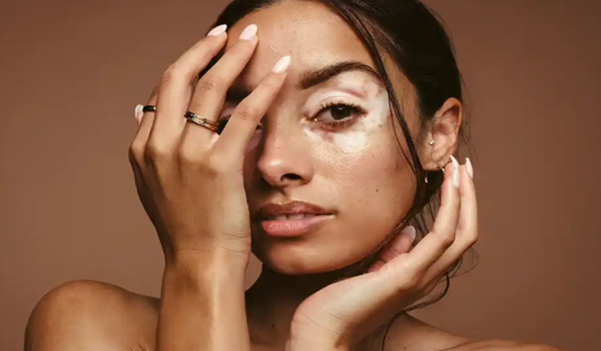 Vitiligo hastalığı nedir? Nasıl tedavi edilir?