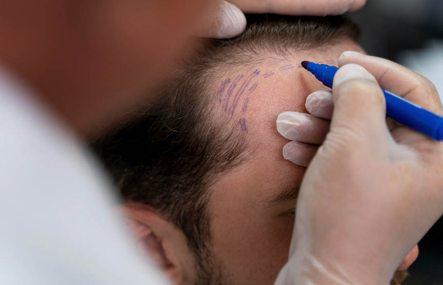 Sac Dokulmesi Nasıl Olur