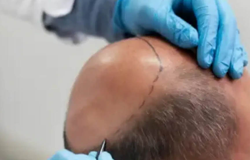 Saç Ekilmesi Şartları