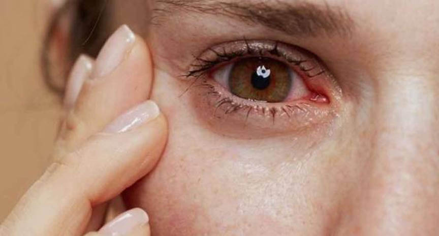 Göz Kuruluk Dogal Yollar